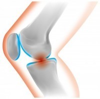 ランナー膝の症状