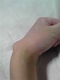 ガングリオンの症状